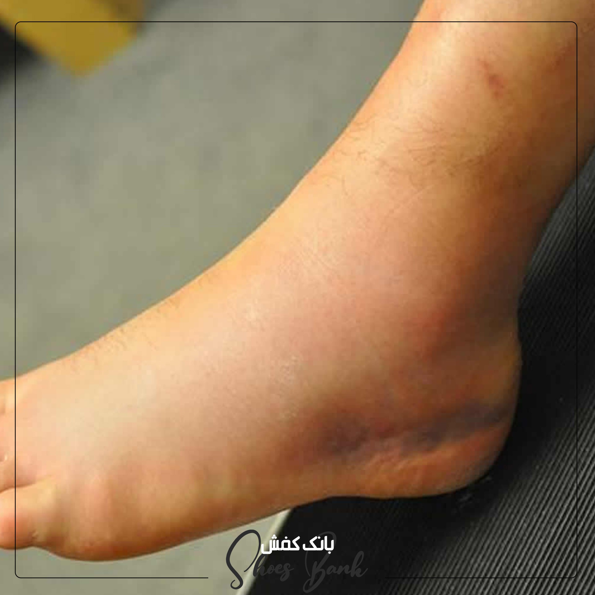 ورم پا در بارداری
